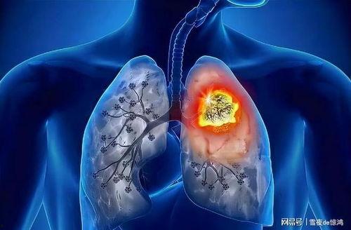 肺结节可以吃瓜嘛