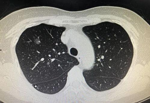 肺结节可以吃瓜嘛